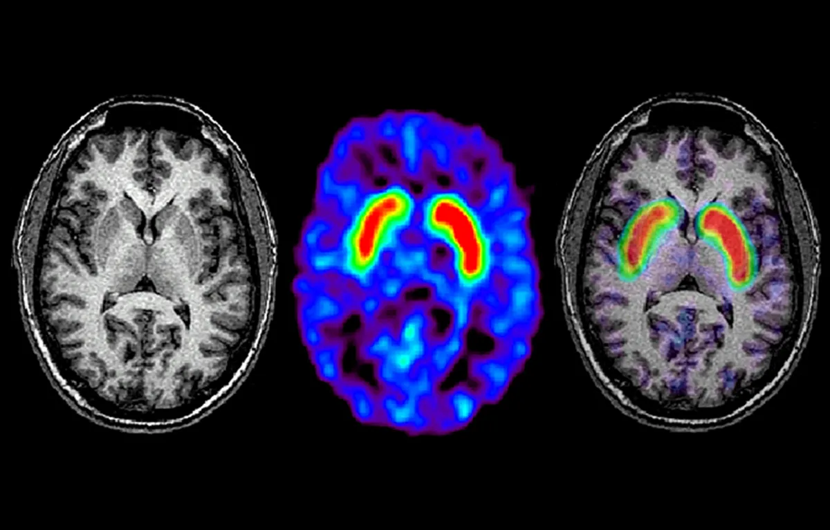 Detecting Parkinson Disease using ML Techniques